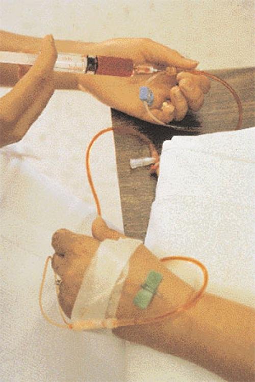 Cheemottheerraapyy sseessssiion iin prrogrreessss (Photo: Michael Anderson)