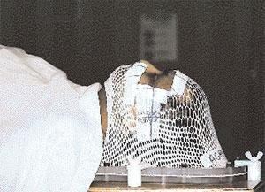 The author being prepared for radiotherapy (CSE)